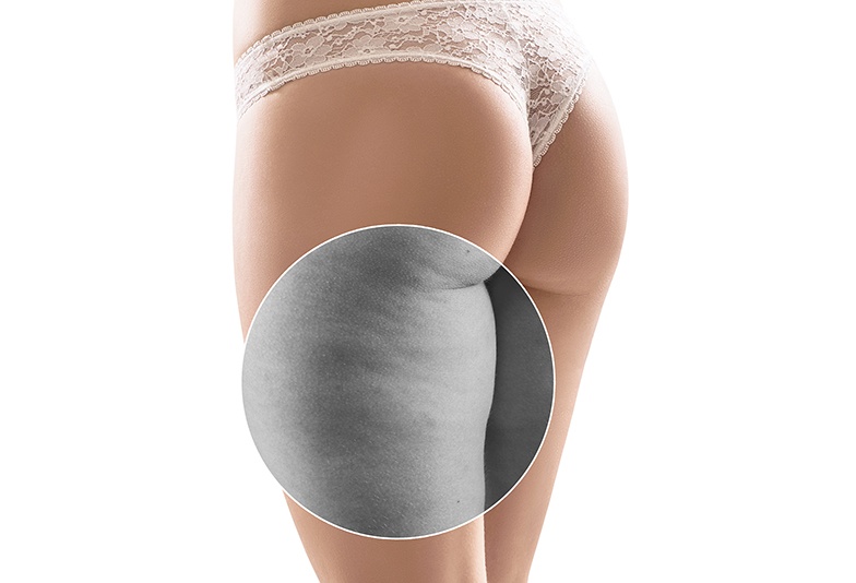 静岡市 エステティシャンが教える 太もものセルライトはどうすれば消える Jewelry Story ジュエリーストーリー ブライダル情報 婚約指輪 結婚指輪 結婚式場情報サイト